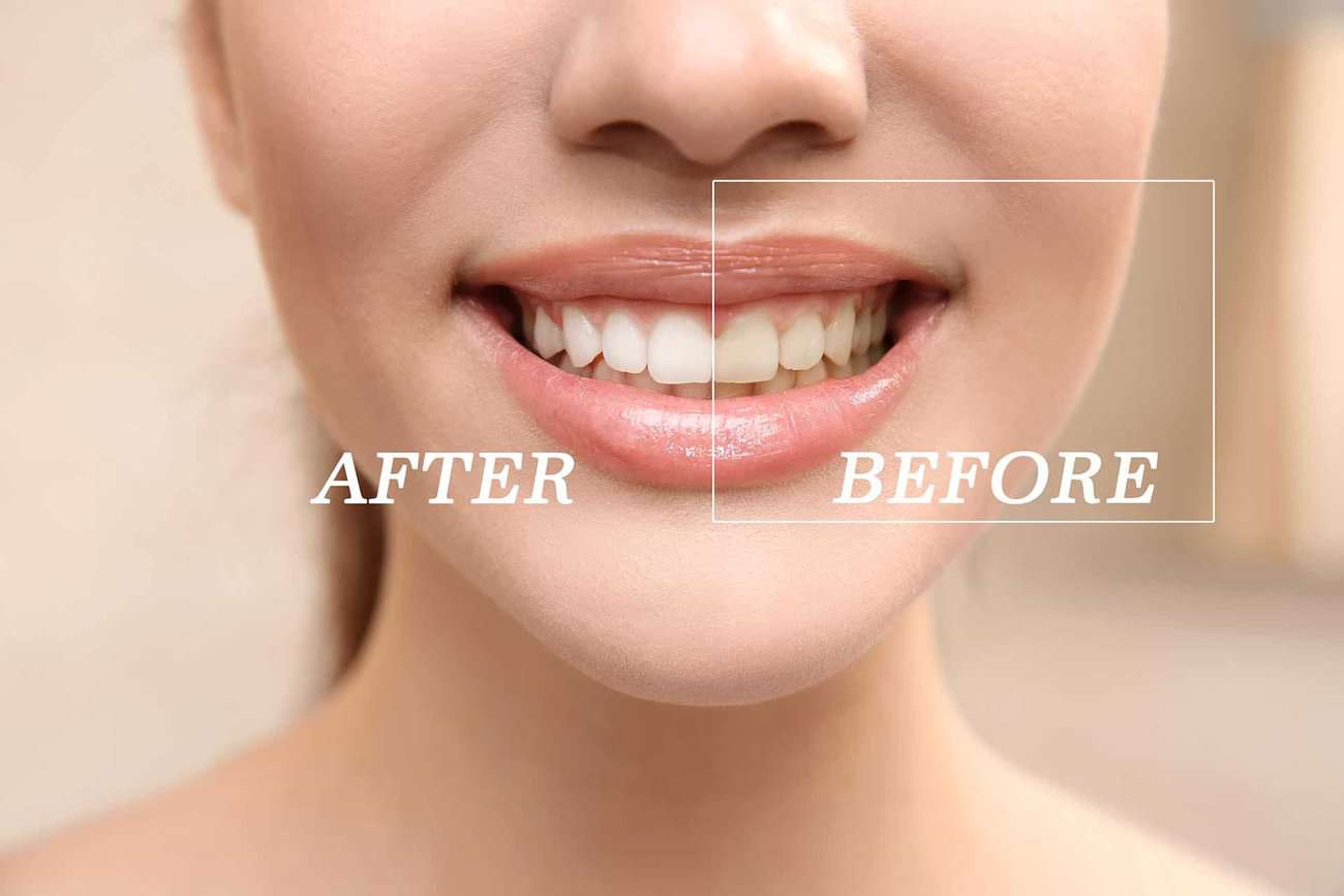 What Are the Most Effective Natural Teeth Whitening Methods You Can Try Kettering?