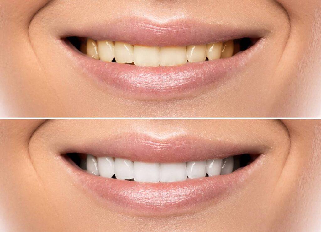 How Does Gum Disease Progress if Left Untreated Kettering?