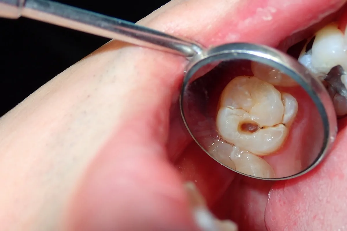 Why Do Teeth Crack? Common Causes to Know Kettering