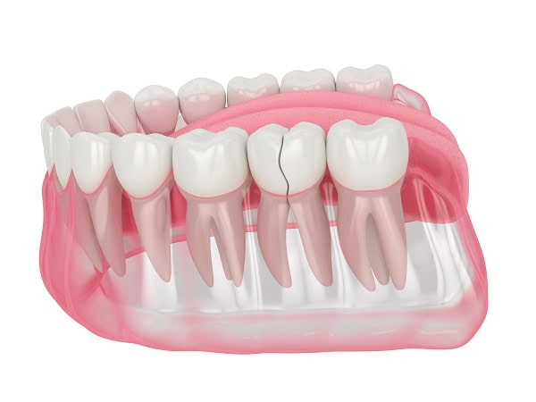 How Can You Manage Pain and Discomfort After a Root Canal Kettering?