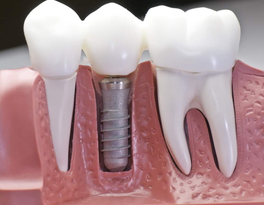 Who Is a Good Candidate for Dental Implants Kettering?