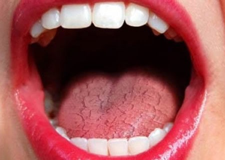 Dry Mouth and Its Role in Tooth Decay Kettering