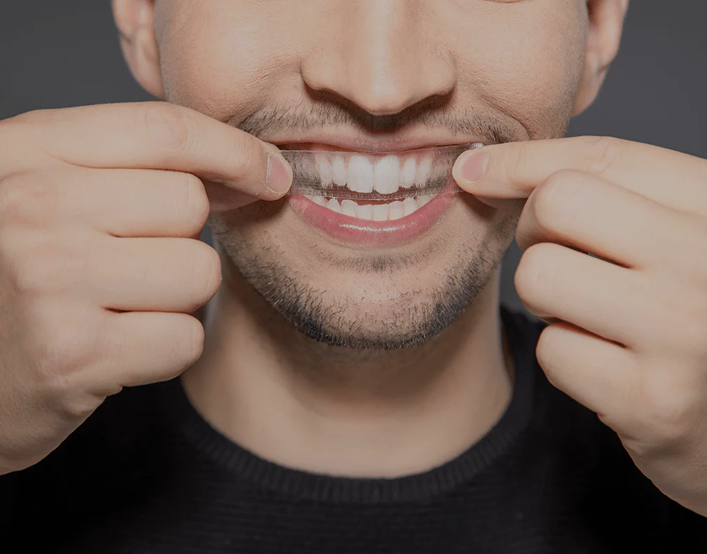 Can You Whiten Natural Teeth Without Harsh Chemicals Kettering?