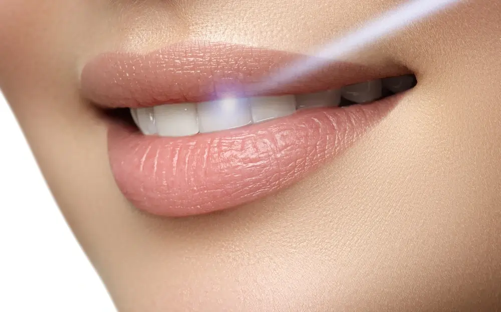 A Smarter Alternative: At-Home Laser Teeth Whitening Kettering