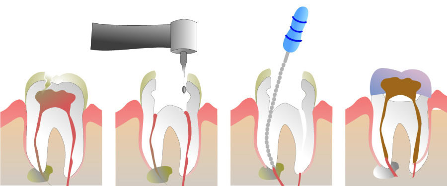 How Do You Properly Care for Your Teeth After a Root Canal Kettering