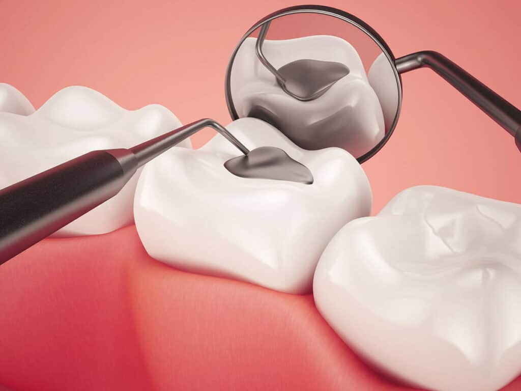 How Can You Prevent Tooth Decay Effectively Kettering