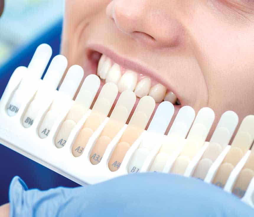 Professional vs At-Home Whitening: What You Need to Know Kettering