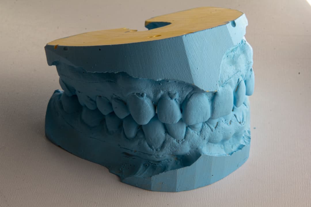 How Do Dental Implants Improve Jawbone Health and Oral Function Kettering?