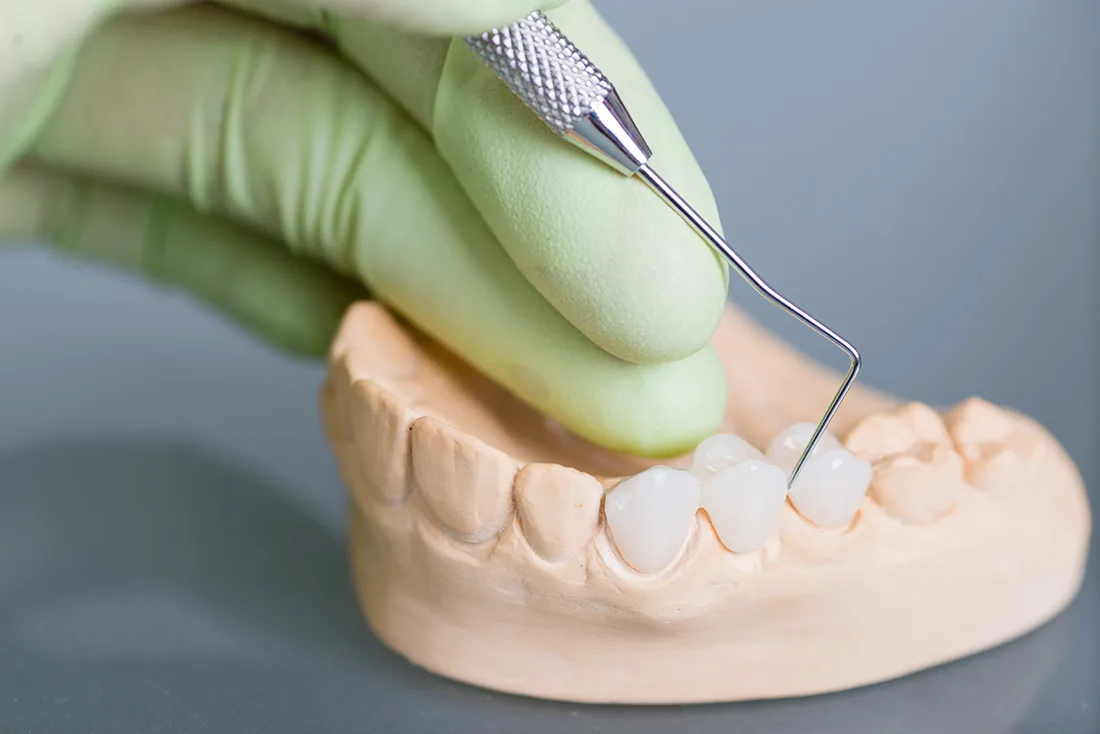 Do Braces Take Years to Show Results Kettering