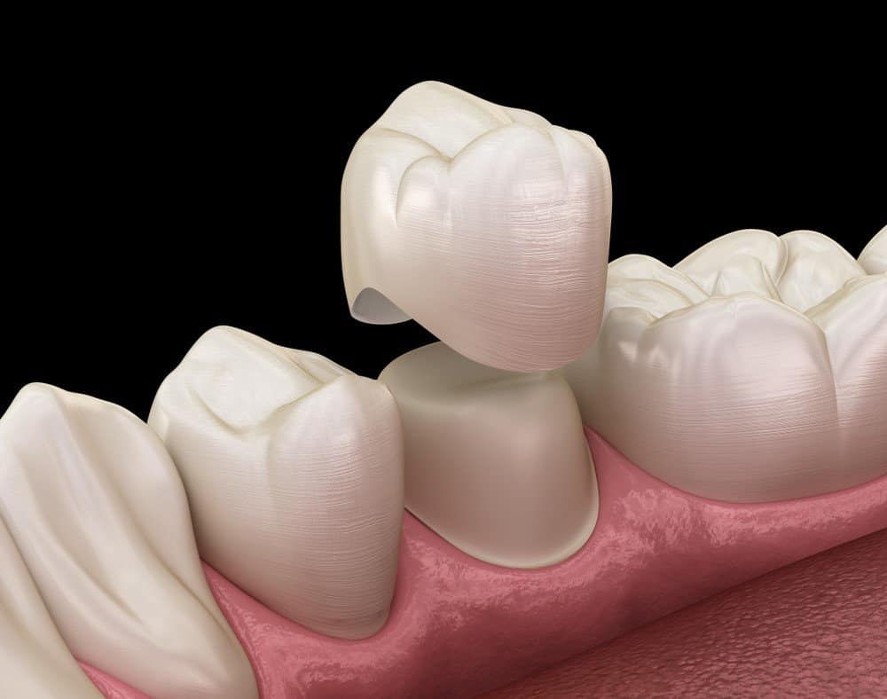 What is the Procedure for Getting Dental Implants Kettering?