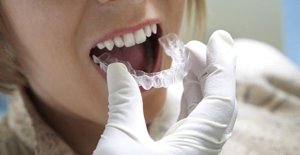 Why Bleaching Trays Require More Time Kettering