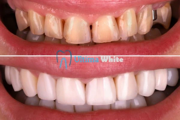 What Makes Instant Teeth Whitening Treatments So Popular Kettering?