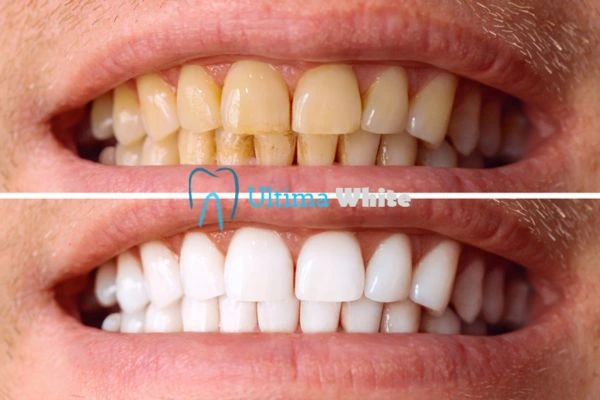 Stained Teeth and Persistent Bad Breath Kettering