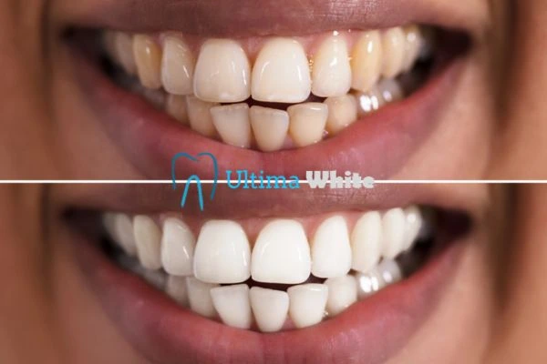 Aftercare Tips to Maintain Your New Smile Kettering
